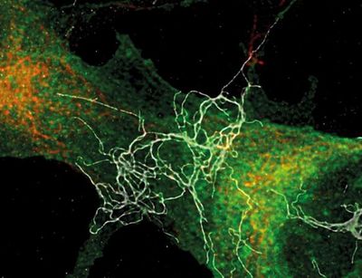 High-resolution confocal laser scanning microscope image of neurotoxic beta-Amyloyd fibrils on neuronal cells.