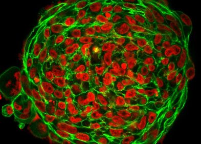 Aktin- und DNA-Färbung verraten die Struktur von 3D-Tumorclustern. Zellformen in Krebstumoren zeigen an, ob die Zellen beweglich sind. Aktin- und DNA-Färbung verraten die Struktur von 3D-Tumorclustern. Zellformen in Krebstumoren zeigen an, ob die Zellen beweglich sind.